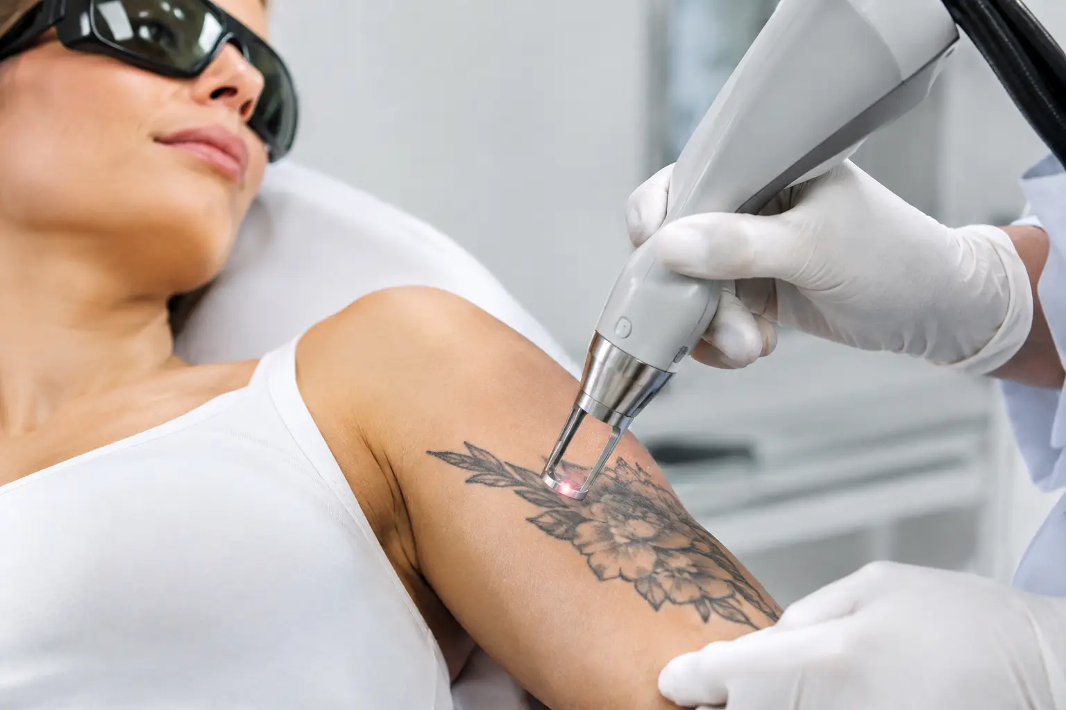 Come rimuovere i tatuaggi con il laser