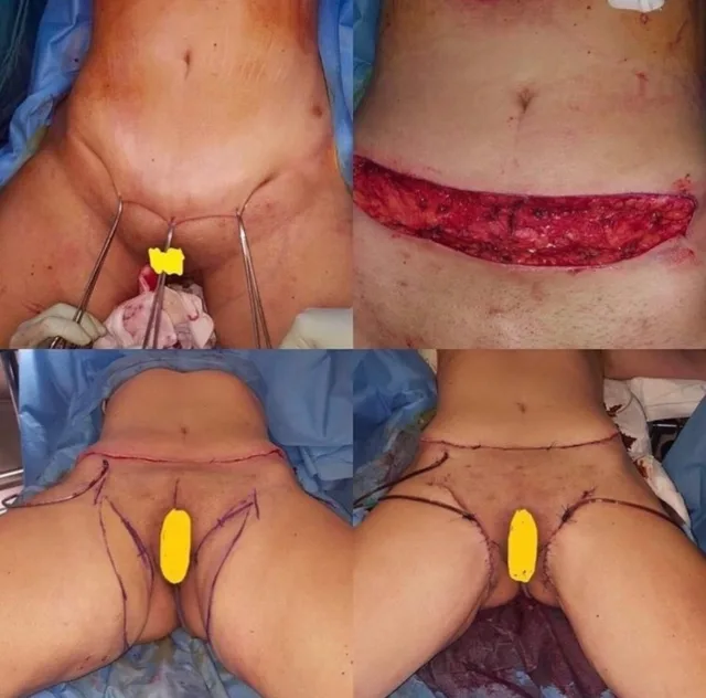 Miniaddominoplastica e lifting delle cosce #chirurgiaplastica #chirurgiaplasticapalermo #chirurgiaesteticapalermo #addominoplastica #liftingcoscie #palermo #aesthetic