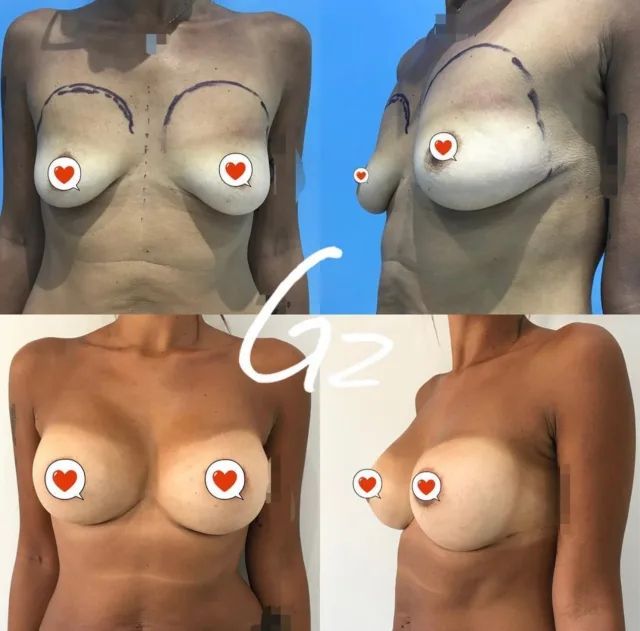 Mastoplastica additiva con protesi rotonde #mastoplastica #mastoplasticapalermo #mastoplasticacatania #aumentoseno #chirurgoplasticopalermo #chirurgoplasticocatania #chirurgoesteticopalermo #giovannizabbia