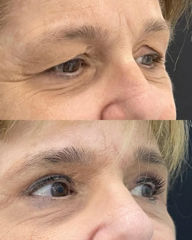 Blefaroplastica superiore 👁️

Risultato a 3 mesi ✨

Ci trovi a Palermo in Via Ricasoli 45

#chirurgiaplasticapalermo #chirurgiaesteticapalermo #blefaroplastica #blefaroplasticasuperiore #chirurgiapalpebrale #palpebre
