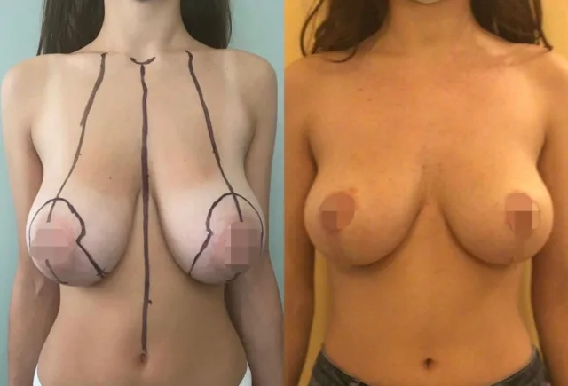 Mastoplastica riduttiva #mastoplastica #mastoplasticariduttiva #riduzioneseno #chirurgoplasticopalermo #chirurgoesteticopalermo #giovannizabbia