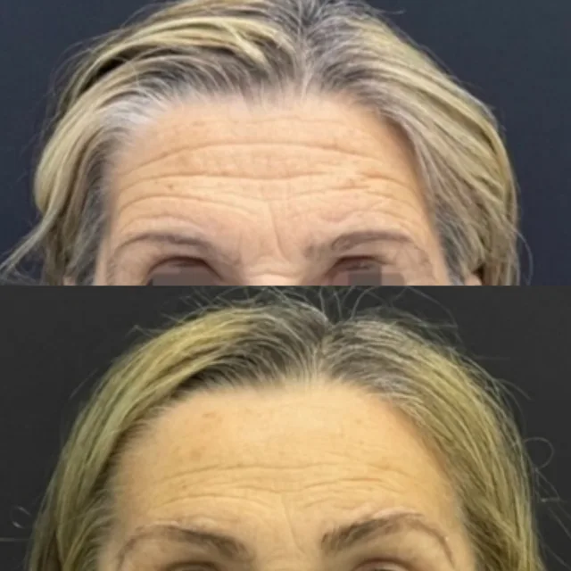 Alleviare le rughe frontali stabilmente con un lifting frontale con accesso bicoronale.RISULTATO PERMANENTE #lifting #frontallift #facialtreatment #facialrenjuvenation #frontalrejuvenation #chirurgoplasticopalermo #chirurgoesteticopalermo #palermo #instagood #instagram