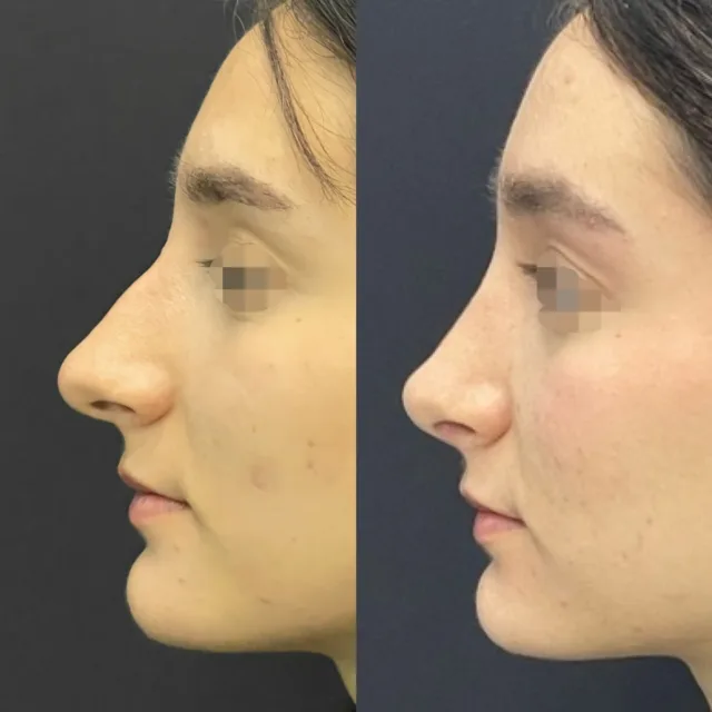 Rinoplastica strutturale open, settoplastica e riduzione turbinati per migliorare la funzione respiratoria. La rinoplastica open ci permette di valutare più accuratamente i difetti da correggere e in maniera simmetrica. Inoltre, permette di utilizzare meglio, rispetto alla chiusa,  gli  innesti di cartilagine che apportano stabilità alla struttura. #rinoplastica #rinoplasticapalermo #rinoplasticacatania #rinoplasticasicilia #chirurgoplasticopalermo #chirurgoplasticocatania #chirurgoesteticopalermo