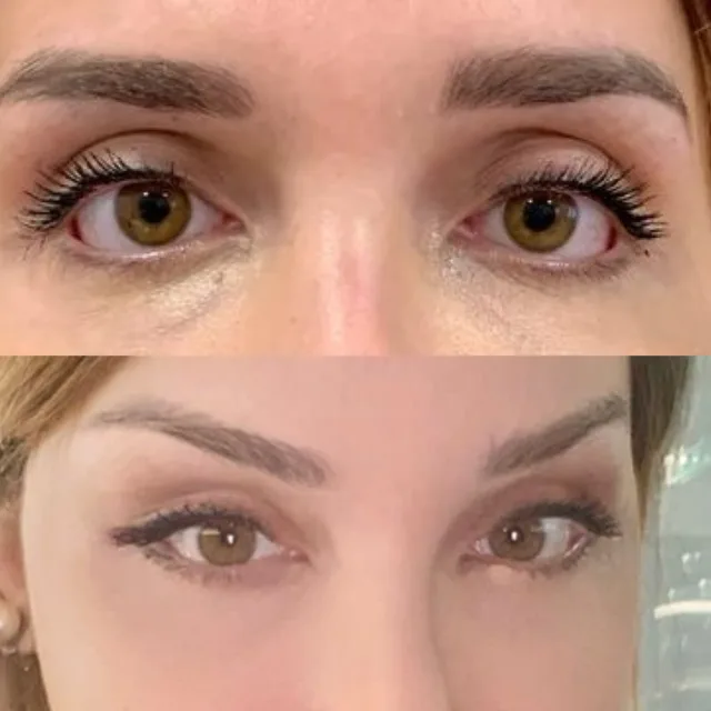 Cantopessi dinamica post 1 anno. Intervento in anestesia locale. #cantopessi #ffs #facialfeminizationsurgery #chirurgoplasticopalermo #chirurgoplasticosicilia #chirurgoesteticopalermo #facelift