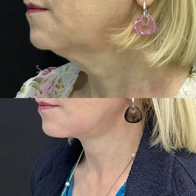 Lifting chirurgico del collo e resezione del tessuto adiposo per riduzione della pelle in eccesso sotto mentoniera #necklif #facelift #lifting #chirurgoplasticopalermo #chirurgoesteticopalermo #giovannizabbia