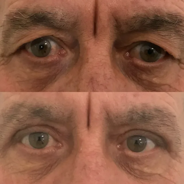 Blefaroplastica superiore #blefaroplasticasuperiore #chirurgiplasticopalermo #chirurgoesteticopalermo #palermo#palpebre #ptosipalpebrale