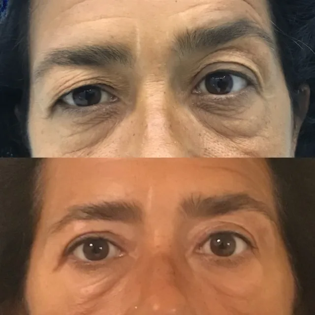 Correzione di asimmetria palpebrale e frontale #chirurgoplastico #chirurgoplasticopalermo #chirurgoesteticopalermo #blefaroplastica