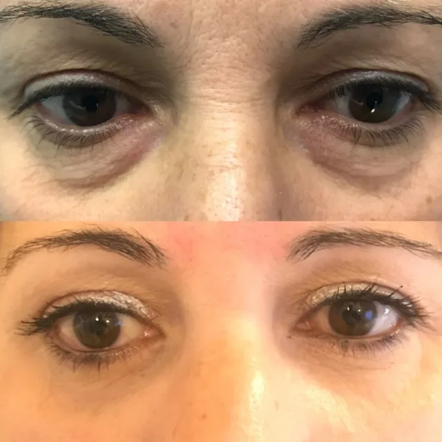 Blefaroplastica inferiore con riduzione del tessuto adiposo e resezione cutanea #blefaroplastica #chirurgoplasticopalermo #chirurgiesteticopalermo #palpebre #borsepalpebrali #palermo