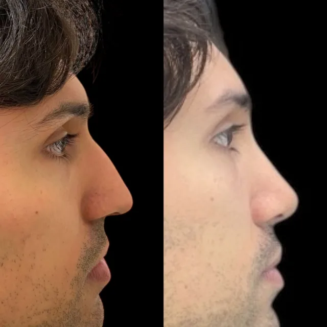 Rinosettoplastica #rinoplastica #rinosettoplastica #rinoplasticapalermo #chirurgoplasticopalermo #chirurgoesteticopalermo #naso #clinicachirurgiaplastica