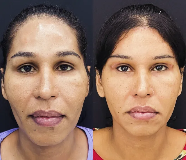 Ringiovanimento facciale chirurgico #faciarejuvenation #cantopessi #ringiovanimentofacciale #aumentomalare#blefaroplastica#facelift #lifting #chirurgoplasticopalermo #chirurgoesteticopalermo #chirurgoplasticocatania #chirurgoplasticobrescia #chirurgoesteticocatania