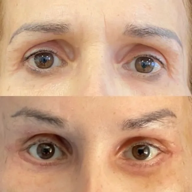 Brow lift temporale e cantopessi dinamica #browlift #cantopessi #chirurgoplasticopalermo #chirurgoesteticopalermo #chirurgoplasticobrescia #chirurgoesteticobrescia