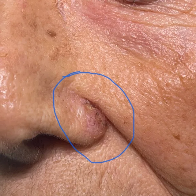 Asportazione di carcinoma basocellulare dell’ala del naso. Ricostruzione con lembo di avanzamento rotazione. Risultato a 3 mesi dall’intervento.  #carcinomanaso #basalioma #chirurgiaplasticapalermo #chirurgiaesteticapalermo #chirurgoplasticopalermo